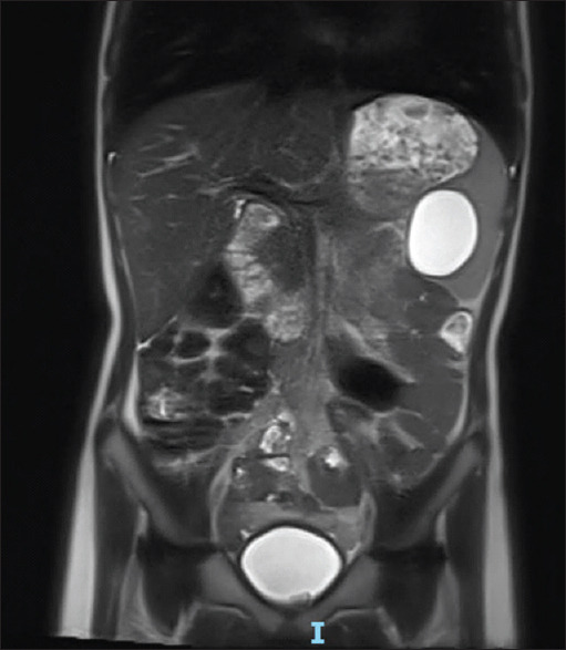 Epidermoid Splenic Cyst in Children Treated by Laparoscopic Partial Splenectomy.