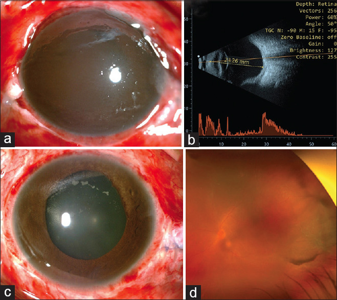 Anterior segment ischemia following scleral buckle surgery: The forgotten enemy.