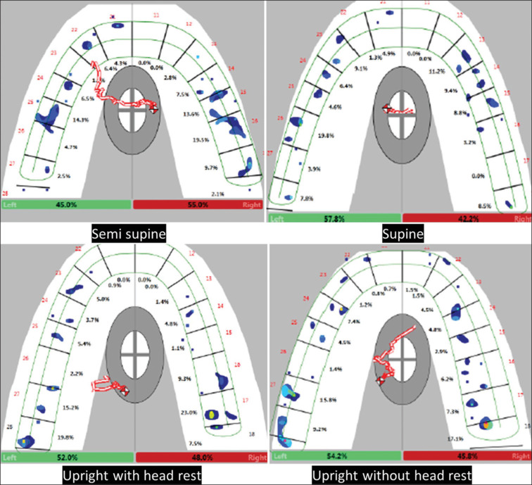 An analysis of three dimensional changes to comprehensively evaluate the occlusion time, disclusion time, point of first contact and force distribution at various head positions using Tekscan III: An in vivo study.