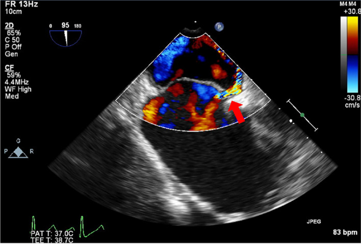 Dynamic shunt flow alterations through patent foramen ovale during off-pump coronary artery bypass grafting induced by airway pressure changes: a case report.