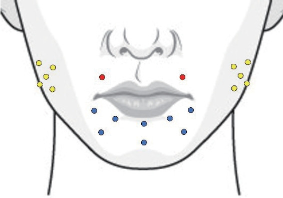 Treatment of a lip defect in a patient with chorea-acanthocytosis using a combination of surgical and adjuvant onabotulinumtoxinA therapy: a case report.