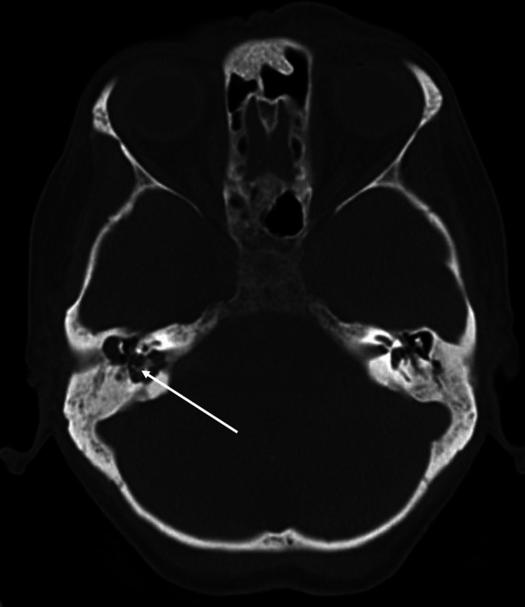 Cranial nerves bridging the middle ear and cerebellum causing cerebellar peduncle abscess: A case report.