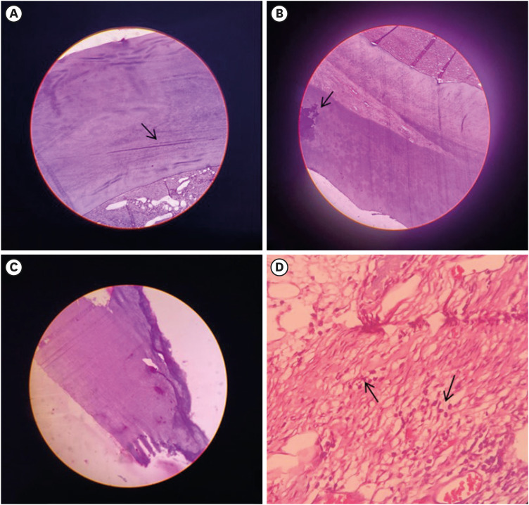 Histological evaluation of pulp response to alendronate and Biodentine as pulp capping agents: an animal study.