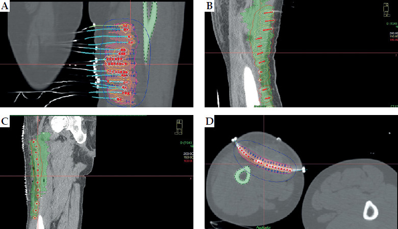 In-depth feasibility study on conservative surgery, perioperative high-dose-rate brachytherapy, and external beam radiation therapy, with a focus on interstitial brachytherapy for soft tissue sarcomas: Insights from a single-institute experience.