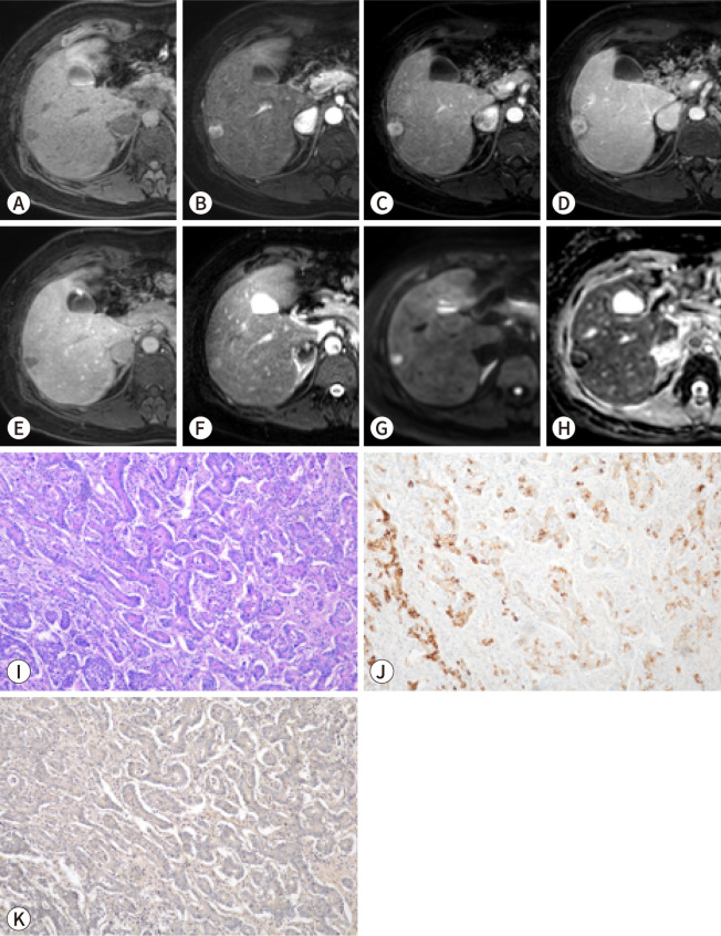 Imaging findings of intrahepatic cholangiocarcinoma for prognosis prediction and treatment decision-making: a narrative review.