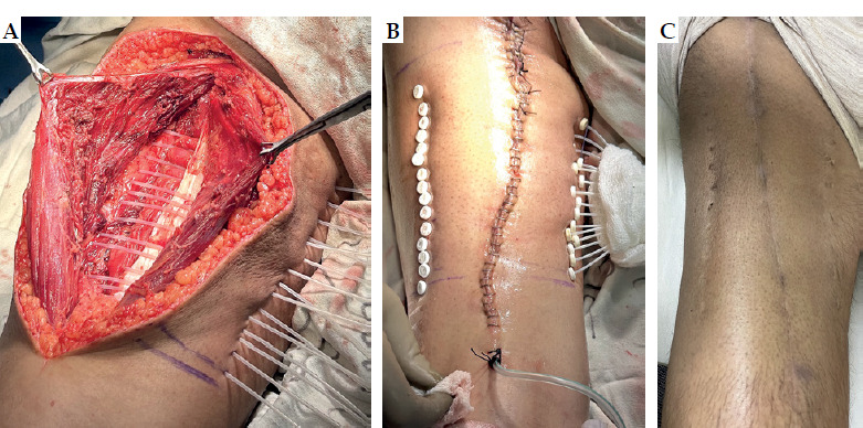 In-depth feasibility study on conservative surgery, perioperative high-dose-rate brachytherapy, and external beam radiation therapy, with a focus on interstitial brachytherapy for soft tissue sarcomas: Insights from a single-institute experience.