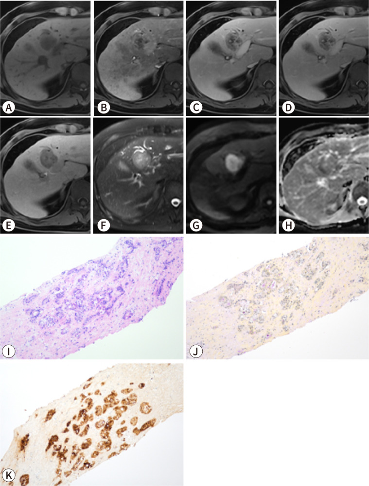 Imaging findings of intrahepatic cholangiocarcinoma for prognosis prediction and treatment decision-making: a narrative review.