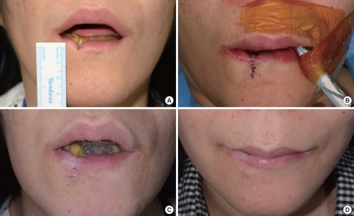 Treatment of a lip defect in a patient with chorea-acanthocytosis using a combination of surgical and adjuvant onabotulinumtoxinA therapy: a case report.