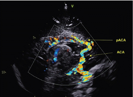 Intraoperative transfontanelle ultrasonography for pediatric patients.