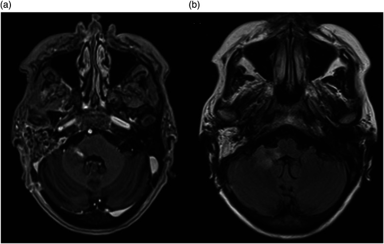 Cranial nerves bridging the middle ear and cerebellum causing cerebellar peduncle abscess: A case report.