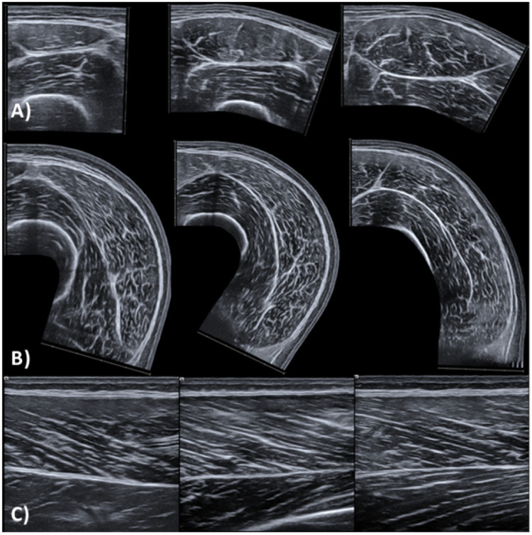 Quadriceps Muscle Geometry and Strength Throughout Maturation in National-Level Male Soccer Players: A Cross-Sectional Study.