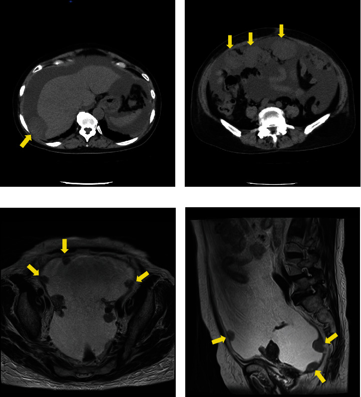 A Case of Carcinosarcoma of the Peritoneum With Serous Tubal Intraepithelial Carcinoma.