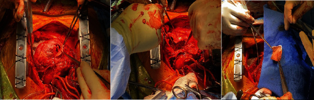 Survival and Recovery From Postmyocardial Infarction Apical Wall Rupture With a Complex Course.