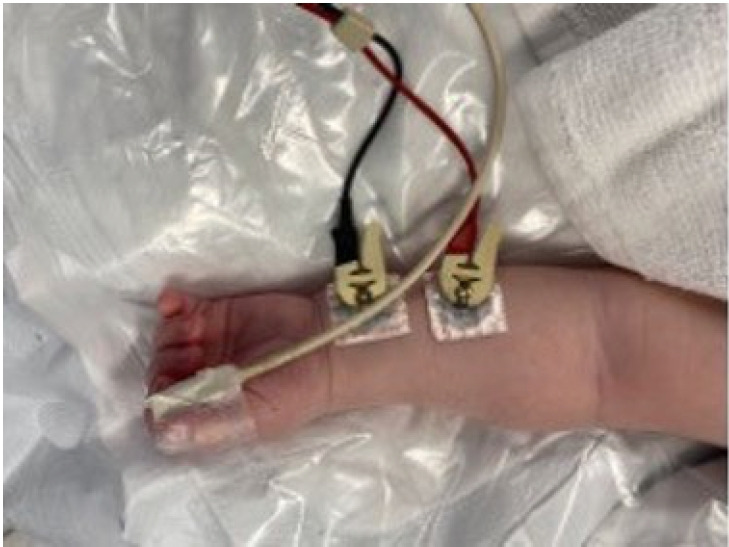 Neuromuscular blockade monitoring in pediatric patients.
