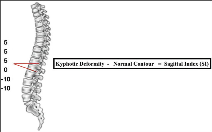 The effectiveness of posterior Schanz screw system in the anatomical restoration of thoracolumbar vertebral burst fractures: A 10-year single-institution experience.