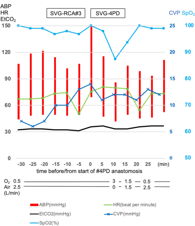 Dynamic shunt flow alterations through patent foramen ovale during off-pump coronary artery bypass grafting induced by airway pressure changes: a case report.