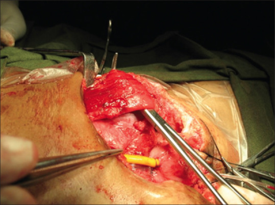 Rectus Muscle Flap-augmented Closures in Wide-gap Exstrophy Bladder.