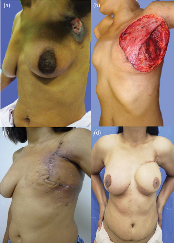 Postmastectomy Late Breast Reconstruction with Transverse Rectus Abdominis Flap after Primary Closure with Latissimus Dorsi.