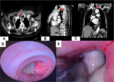 Anaesthesia Management of A Patient with Airway Obstruction Caused by Prosthetic Vascular Graft Invasion into the Tracheal Lumen.
