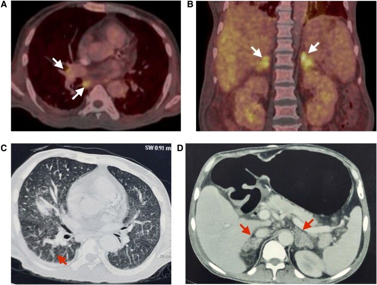 Hypercalcemia Due to Progressive Disseminated Histoplasmosis.