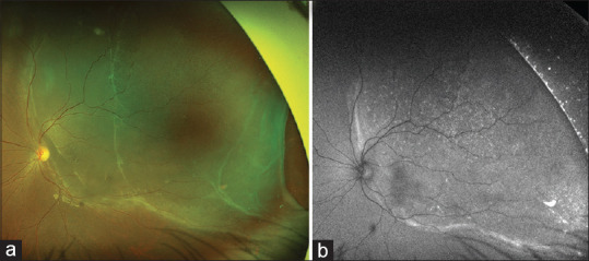 Anterior segment ischemia following scleral buckle surgery: The forgotten enemy.
