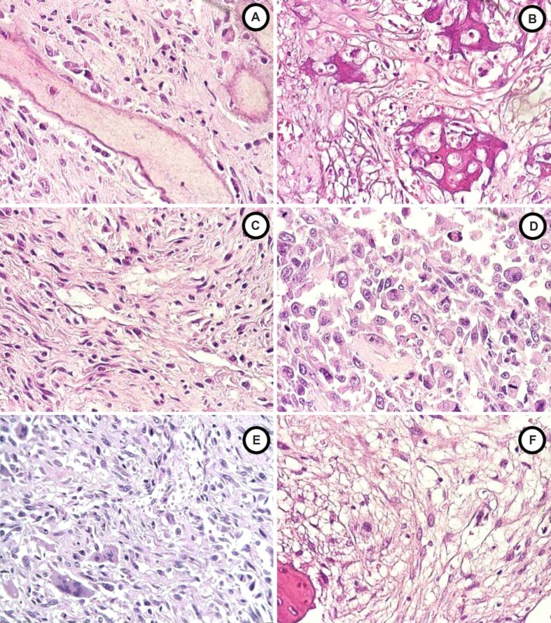 Clinicopathological correlations and prognostic insights in osteosarcoma: a retrospective analysis.