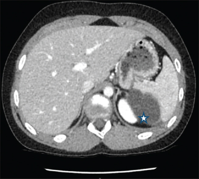 Epidermoid Splenic Cyst in Children Treated by Laparoscopic Partial Splenectomy.