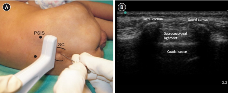 Expert's tips on regional blocks in neonates and infants.