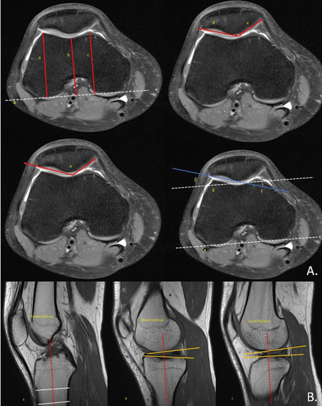 Is Trochlear Dysplasia Associated with a High Prevalence of Repaired Anterior Medial Portal Lesions in Anterior Cruciate Ligament-Deficient Knees?