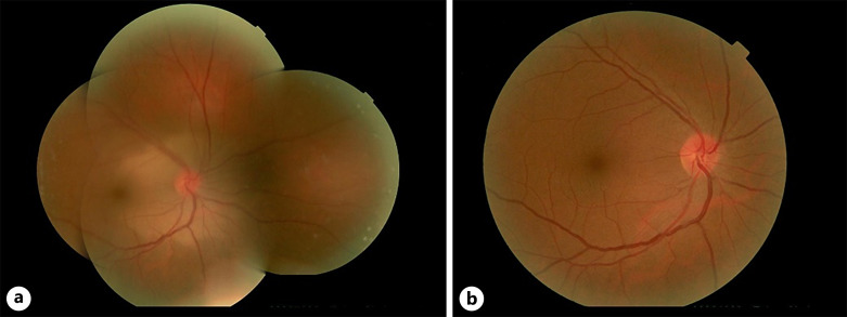 A Successful Case of Intervention for Traumatic Central Retinal Artery Occlusion.