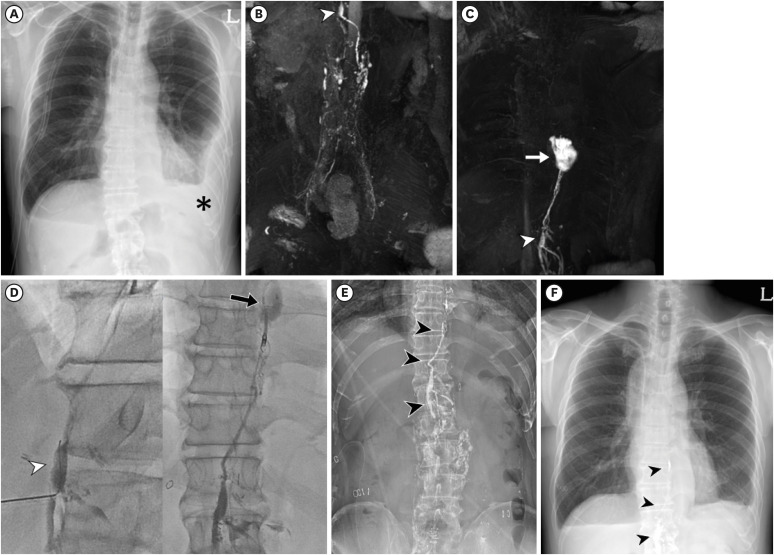 Single-Center Experience With Dynamic Contrast-Enhanced Magnetic Resonance Lymphangiography for Diagnosing Lymphatic Disorders and Guiding Percutaneous Embolization.