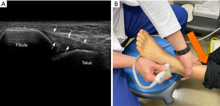 Diagnostic strategies for chronic lateral ankle instability: a narrative review.
