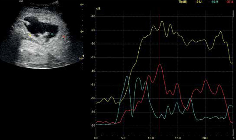 Comparative efficacy of contrast-enhanced ultrasound versus B-mode ultrasound in the diagnosis and monitoring of hepatic abscesses.