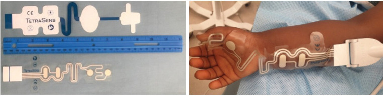 Neuromuscular blockade monitoring in pediatric patients.