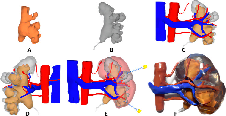 Integrating 3D technology with the Sampaio classification for enhanced percutaneous nephrolithotomy in complex renal calculi treatment.
