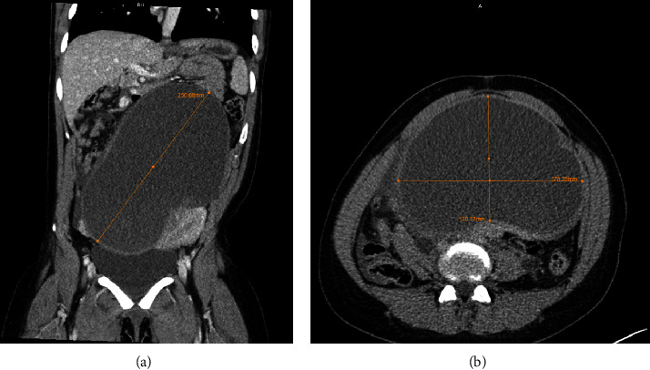 Large Endometrioma That Triggered a Hypertensive Emergency: A Case Report.