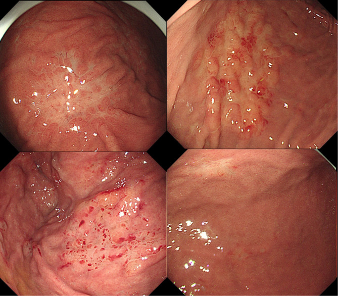 Endoscopic morphology of gastric MALT lymphoma correlate with API2/MALT1 fusion and predict treatment response after helicobacter pylori eradication.