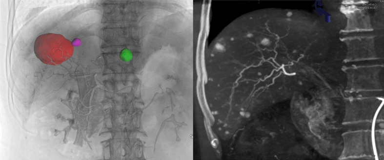 Application of Cone-beam Computed Tomography in Interventional Therapies for Liver Malignancy: A Consensus Statement by the Chinese College of Interventionalists.