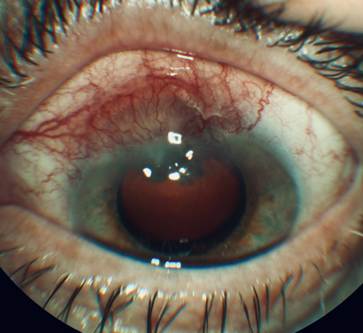 Successful treatment of Keratitis caused by Mycobacterium chelonae and an overview of previous cases in Europe.