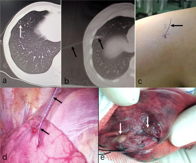 CT-guided microcoil versus hook-wire localization of pulmonary nodule prior to video-assisted thoracoscopic surgery without fluoroscopic guidance.