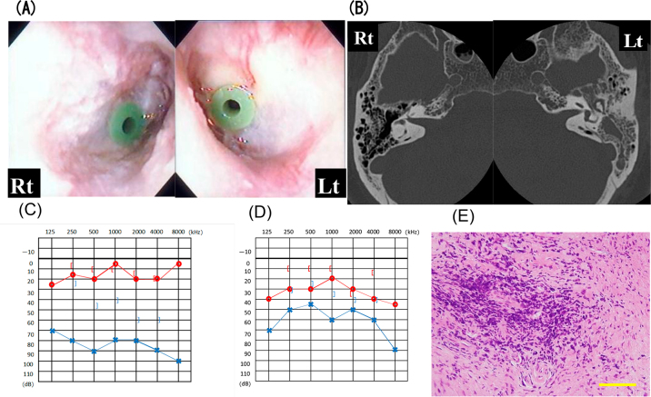 Seven cases illustrating difficulties in the treatment of MPO-ANCA-positive refractory otitis media.