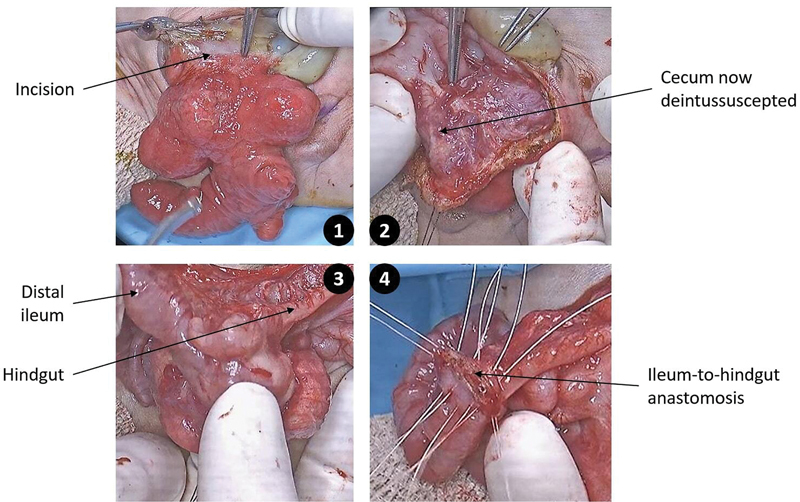 A Modification of the Newborn Operation for Cloacal Exstrophy: Leaving the Cecal Plate Untouched.