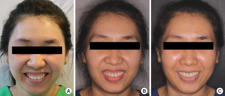 Improvements of facial profile and smile aesthetic using temporary anchorage devices and botulinum toxin: a case report.