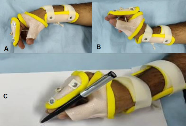 The Effect of a Modified Tenodesis Wrist-hand Orthosis on Hand Function in Patients With Tetraplegia.