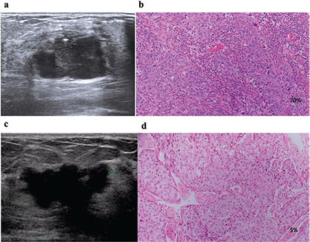 Role of Ultrasonographic and Clinicopathological Characteristics in Assessing Stromal Tumor-Infiltrating Lymphocyte Density in Triple-Negative Breast Cancer