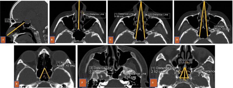 Do Anatomical Variations of Sphenoid Sinus Influence Sella Exposure and Residual Disease in Pituitary Surgery? - A Study in an Indian Population.