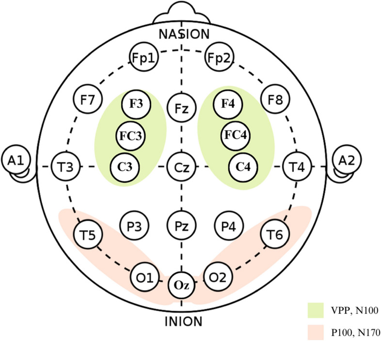 Face and face pareidolia in patients with temporal lobe epilepsy indicates different neural processing: an event-related potential study.