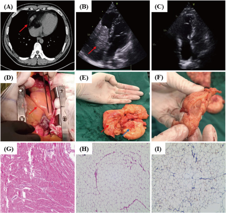 Report of a giant invasive, wall-penetrating cardiac lipoma.