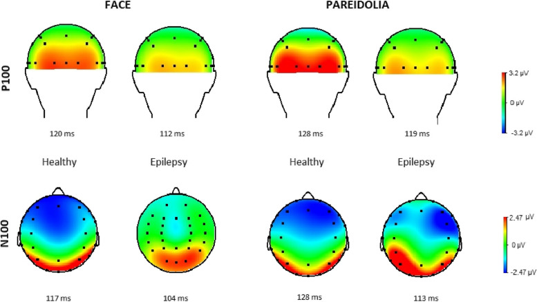 Face and face pareidolia in patients with temporal lobe epilepsy indicates different neural processing: an event-related potential study.