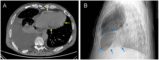 Delayed Diagnosis of Constrictive Pericarditis Resulting in Recurrent Heart Failure: A Case Report.